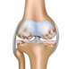 arthritis Knee Pain