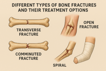 Types of bone fractures and treatment options